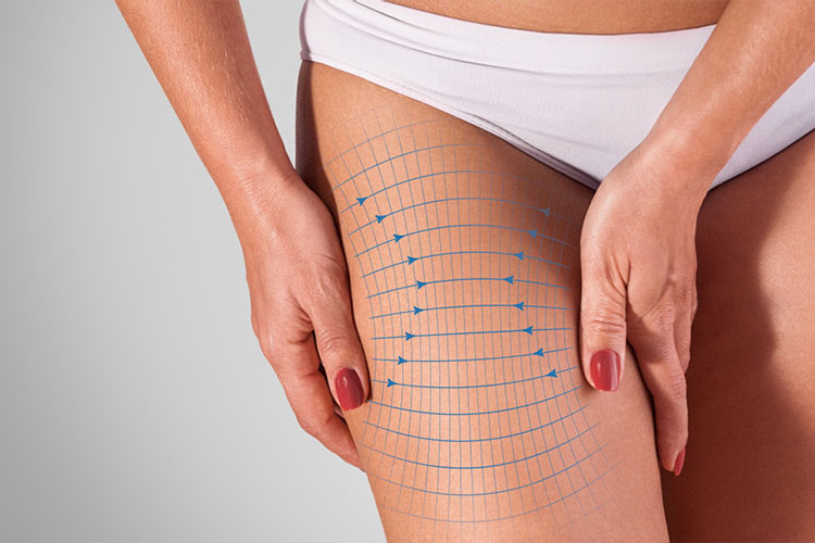 Thigh Lift Surgery (Leg Lift) - Clinic Health Beauty International