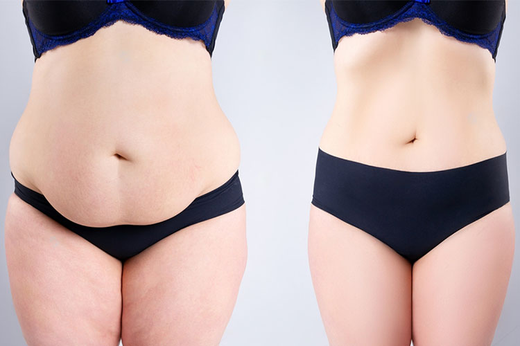Tummy Tuck Recovery FAQ: Answers to Your Questions About Life