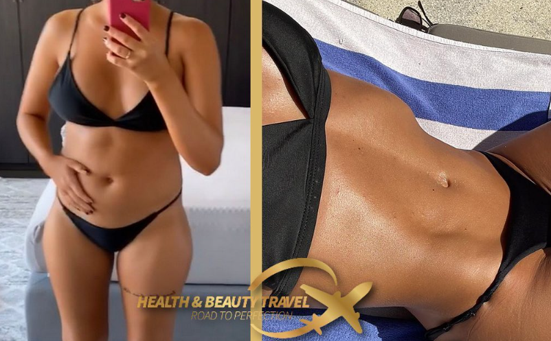 Brazilian Butt Lift - BBL - Clinic Health Beauty International