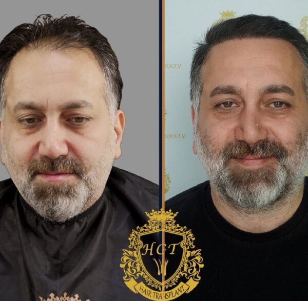 Hair Transplant Before And After Photos In Turkey 1