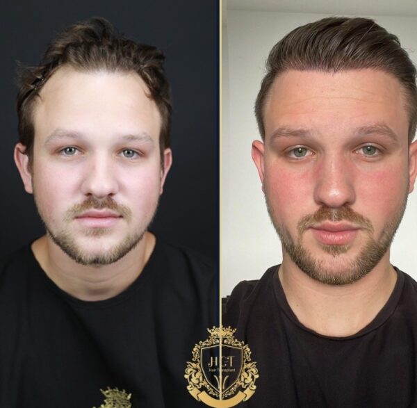Hair Transplant Before And After Photos In Turkey 11