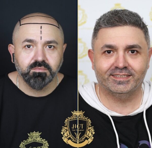 Hair Transplant Before And After Photos In Turkey 12