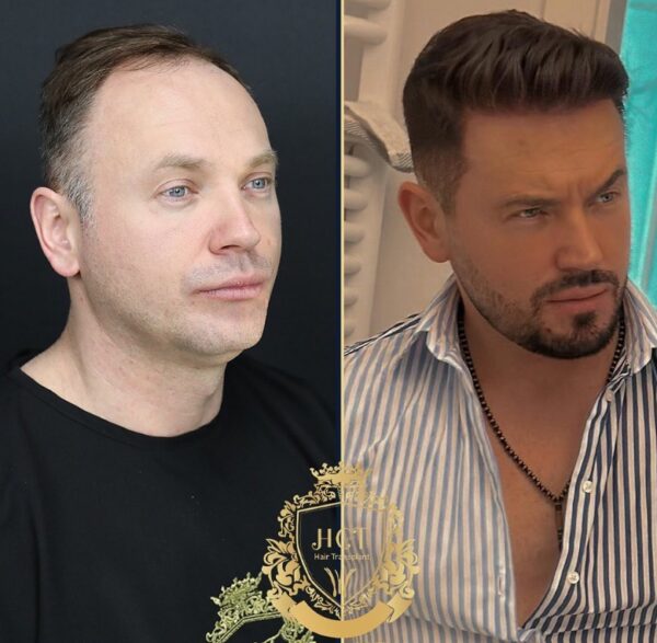 Hair Transplant Before And After Photos In Turkey 14
