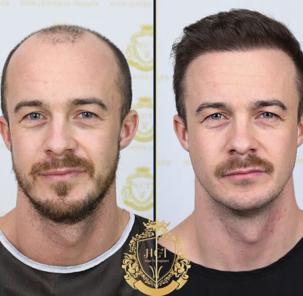 Hair Transplant Before And After Photos In Turkey 17