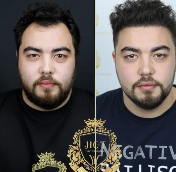 Hair Transplant Before And After Photos In Turkey 19