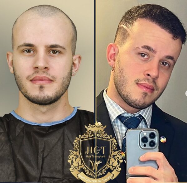 Hair Transplant Before And After Photos In Turkey 20