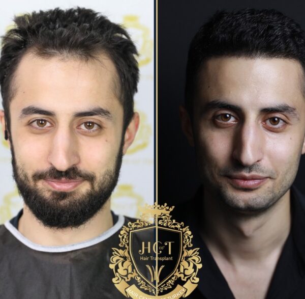 Hair Transplant Before And After Photos In Turkey 21