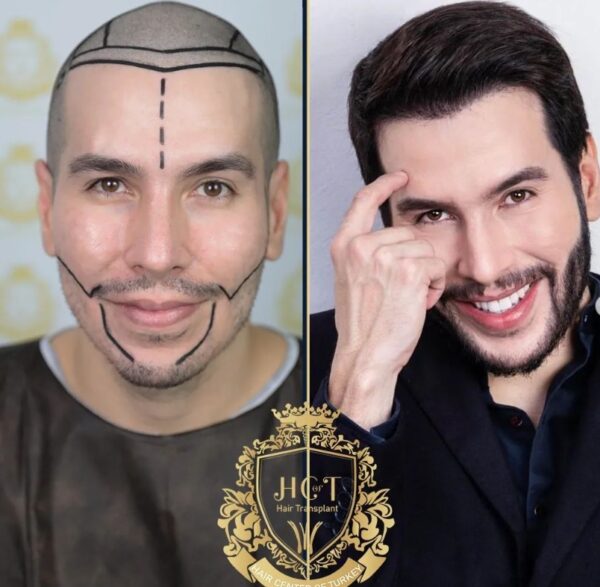 Hair Transplant Before And After Photos In Turkey 23