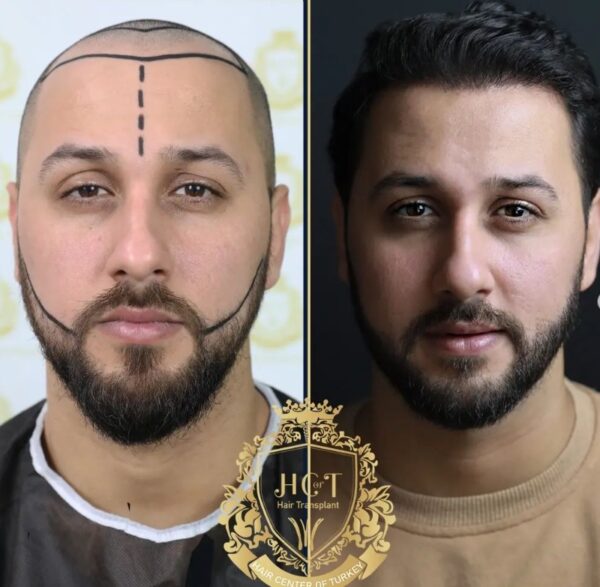 Hair Transplant Before And After Photos In Turkey 25