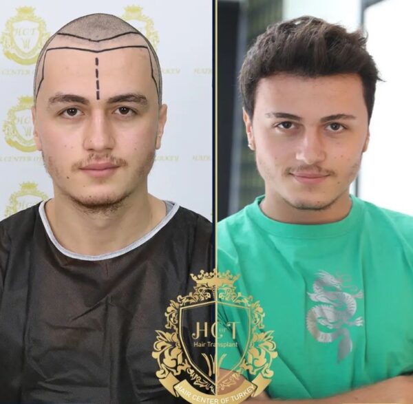 Hair Transplant Before And After Photos In Turkey 26