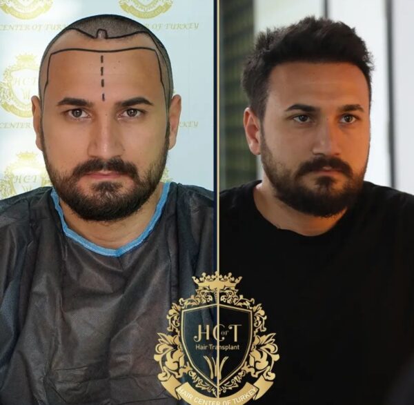 Hair Transplant Before And After Photos In Turkey 27