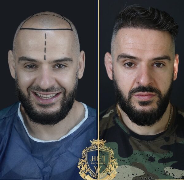 Hair Transplant Before And After Photos In Turkey 29