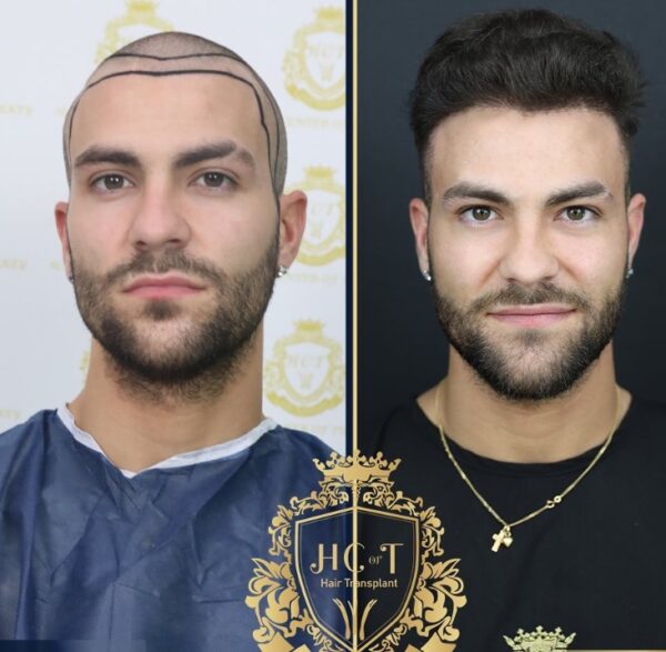 Hair Transplant Before And After Photos In Turkey 30