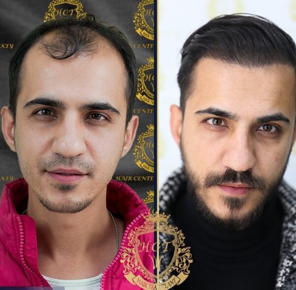 Hair Transplant Before And After Photos In Turkey 31