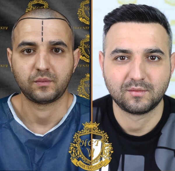 Hair Transplant Before And After Photos In Turkey 36