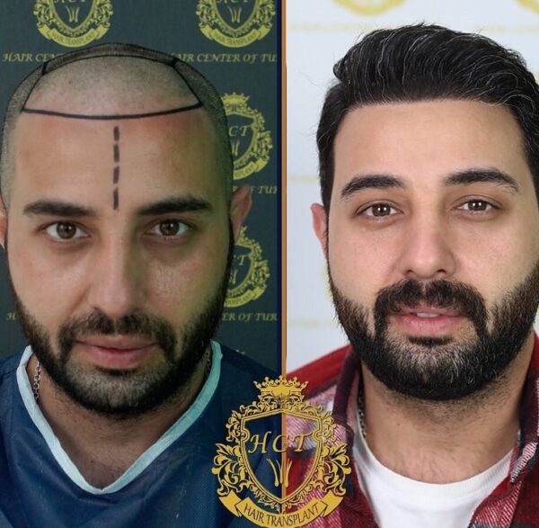 Hair Transplant Before And After Photos In Turkey 37