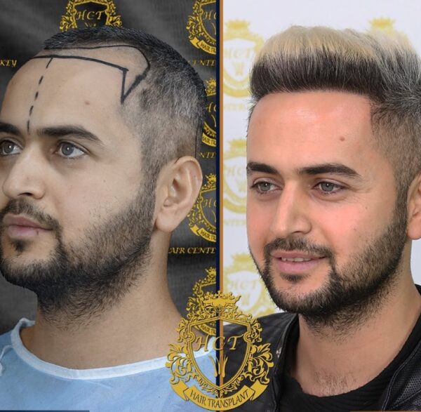 Hair Transplant Before And After Photos In Turkey 39