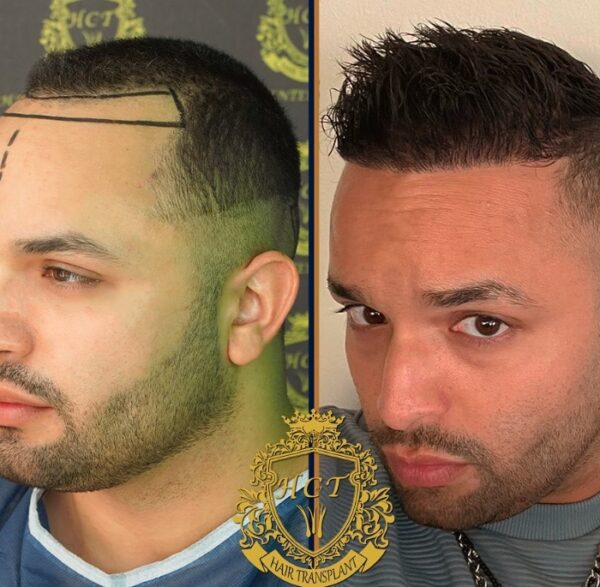 Hair Transplant Before And After Photos In Turkey 40