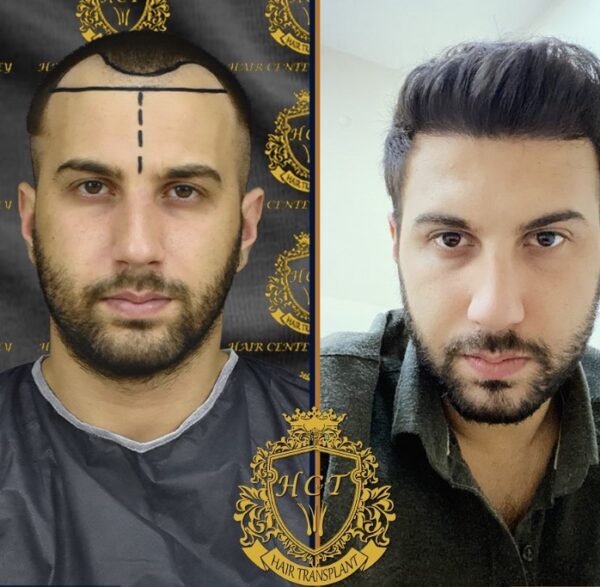 Hair Transplant Before And After Photos In Turkey 41