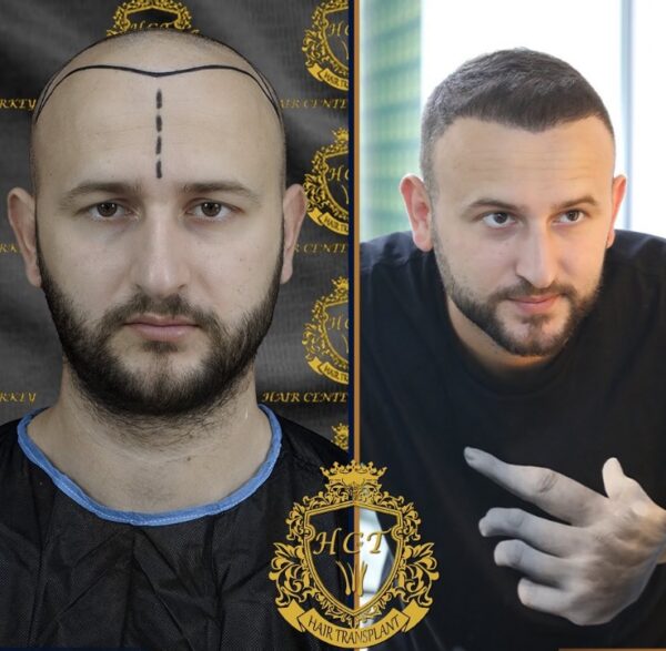 Hair Transplant Before And After Photos In Turkey 42
