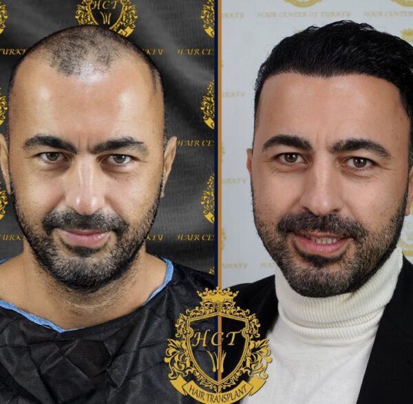 Hair Transplant Before And After Photos In Turkey 43