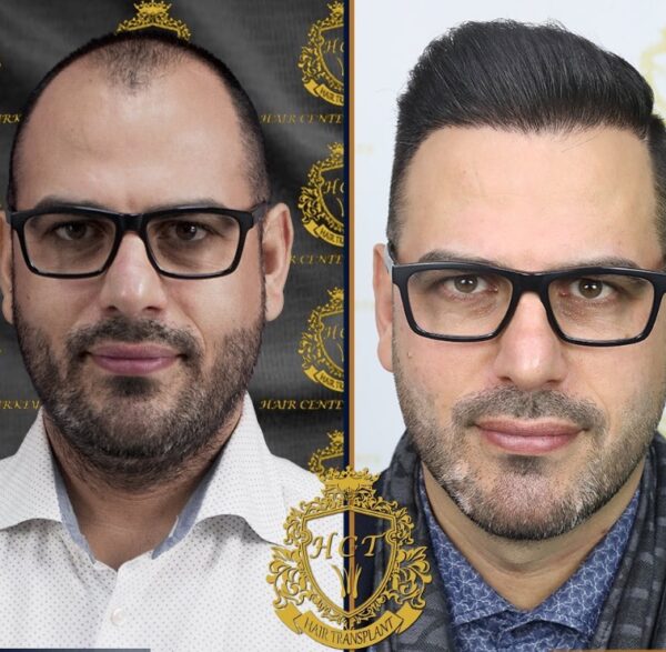 Hair Transplant Before And After Photos In Turkey 44