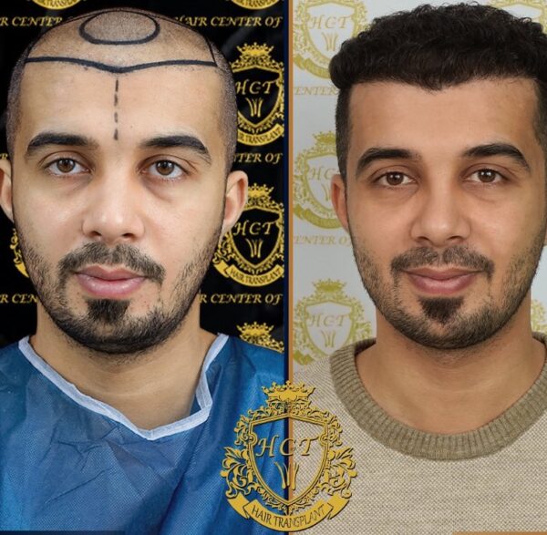 Hair Transplant Before And After Photos In Turkey 45