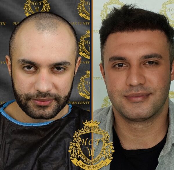 Hair Transplant Before And After Photos In Turkey 46