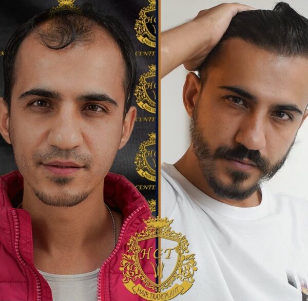 Hair Transplant Before And After Photos In Turkey 47
