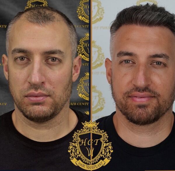 Hair Transplant Before And After Photos In Turkey 48
