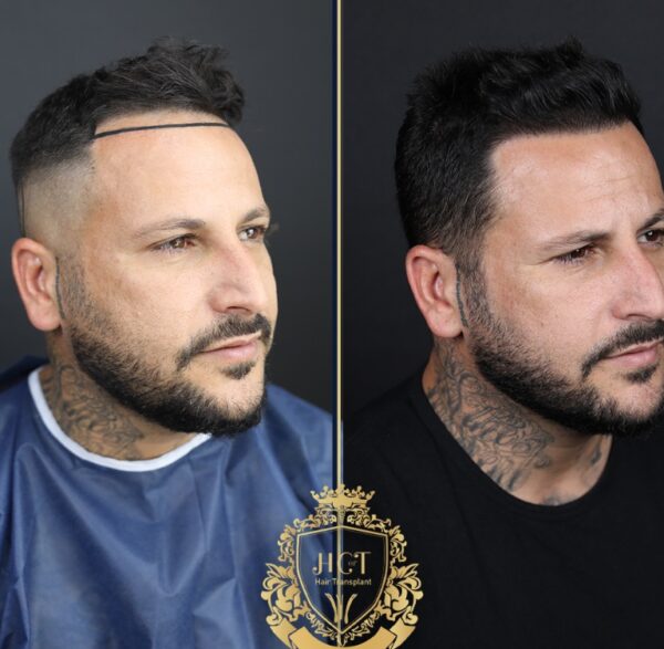 Hair Transplant Before And After Photos In Turkey 5