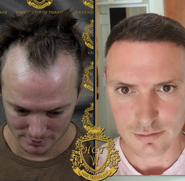 Hair Transplant Before And After Photos In Turkey 50