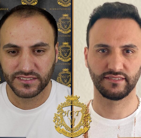 Hair Transplant Before And After Photos In Turkey 53