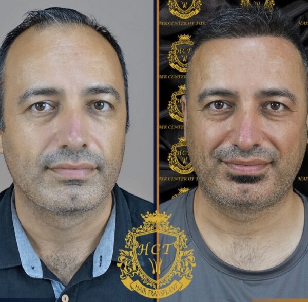 Hair Transplant Before And After Photos In Turkey 54