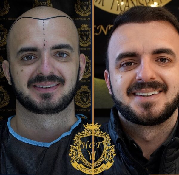 Hair Transplant Before And After Photos In Turkey 56