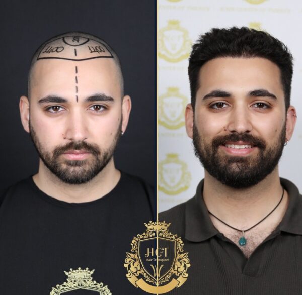 Hair Transplant Before And After Photos In Turkey 6