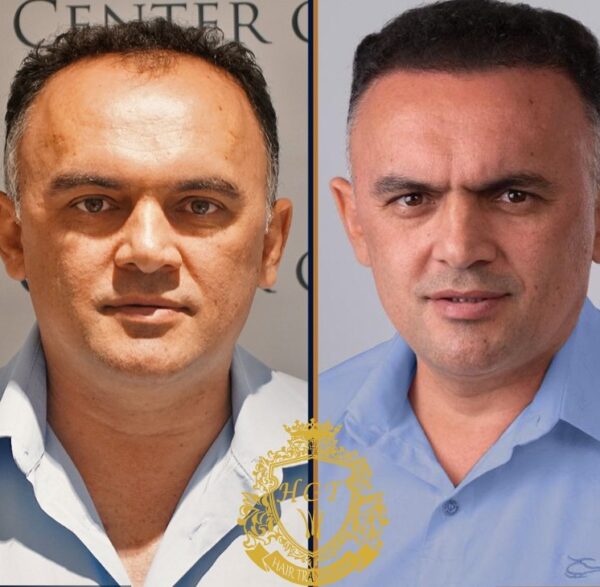 Hair Transplant Before And After Photos In Turkey 60