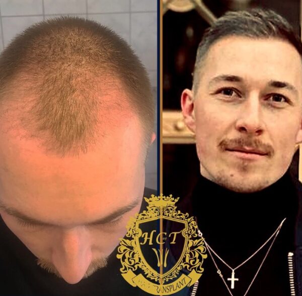 Hair Transplant Before And After Photos In Turkey 61
