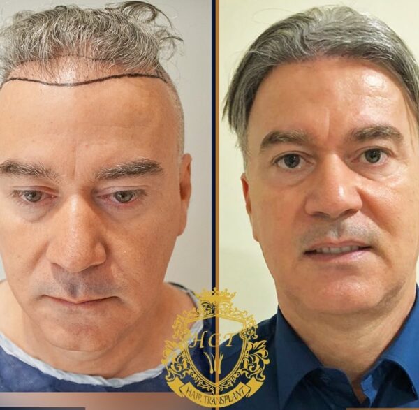 Hair Transplant Before And After Photos In Turkey 62