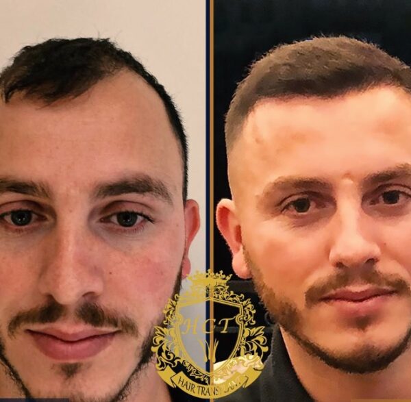 Hair Transplant Before And After Photos In Turkey 63