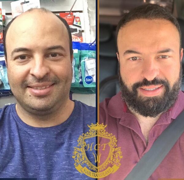 Hair Transplant Before And After Photos In Turkey 64