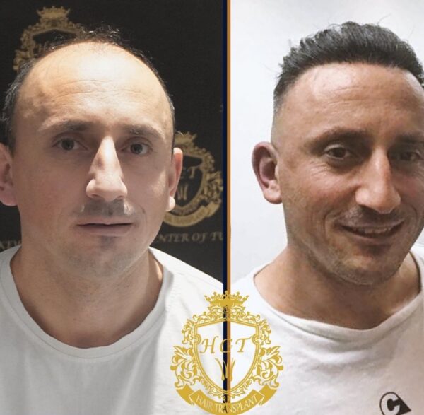 Hair Transplant Before And After Photos In Turkey 65