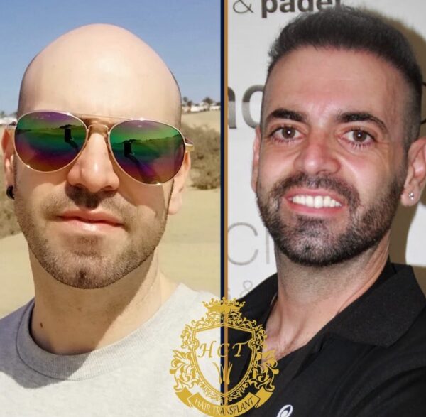 Hair-Transplant-Before-And-After-Photos-In-Turkey-66