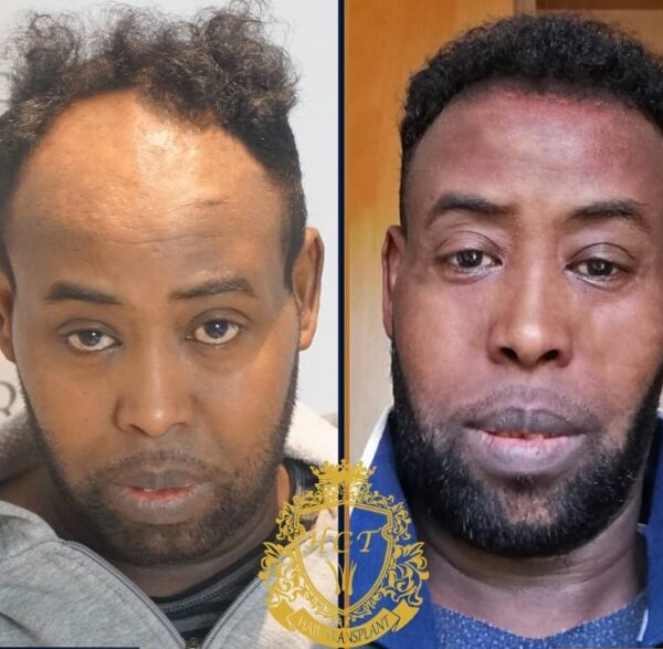 Hair Transplant Before And After Photos In Turkey 67