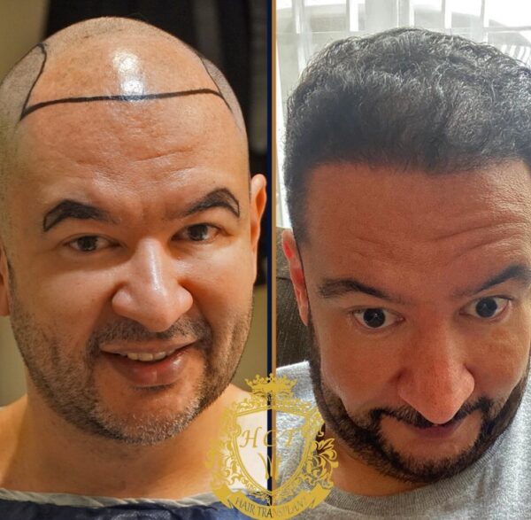 Hair Transplant Before And After Photos In Turkey 68