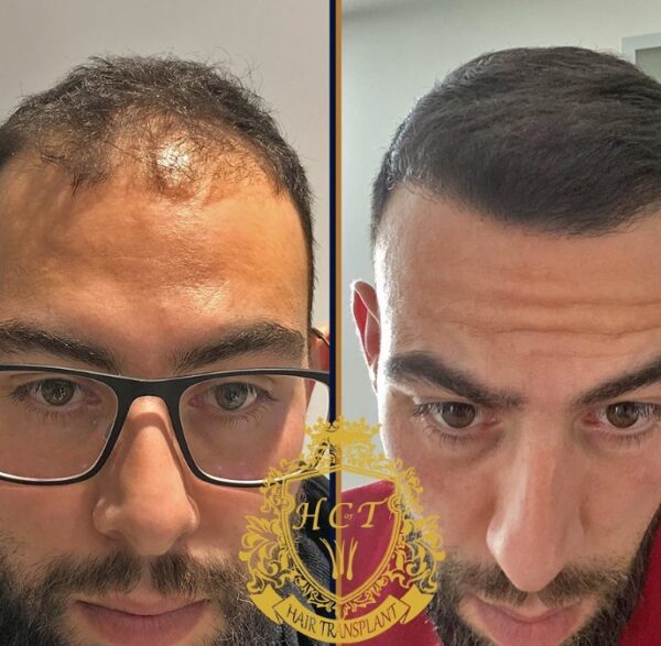 Hair Transplant Before And After Photos In Turkey 69