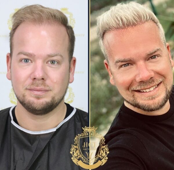 Hair Transplant Before And After Photos In Turkey 7