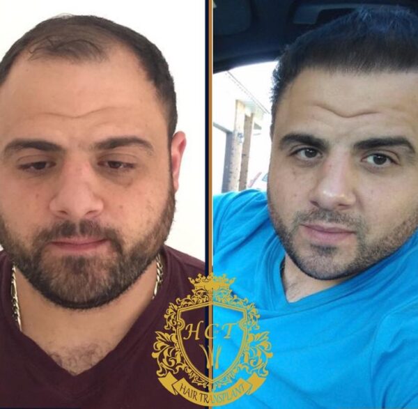 Hair Transplant Before And After Photos In Turkey 70