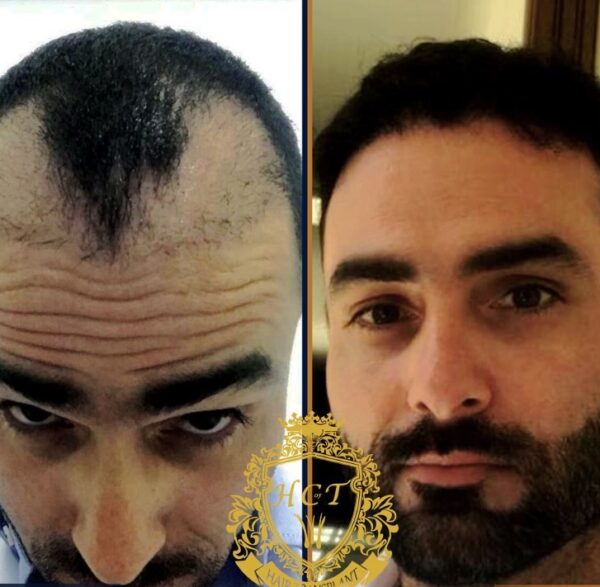 Hair Transplant Before And After Photos In Turkey 72
