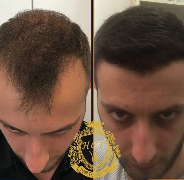 Hair Transplant Before And After Photos In Turkey 73